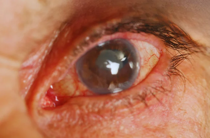 Affordable cataract surgery Chandigarh